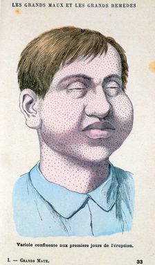 Smallpox victim, c1890. Creator: Unknown