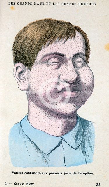 Smallpox victim, c1890. Creator: Unknown.