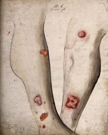Sores and areas of diseased skin on the lower legs of a boy, between 1800 and 1899. Creator: Christopher D'Alton