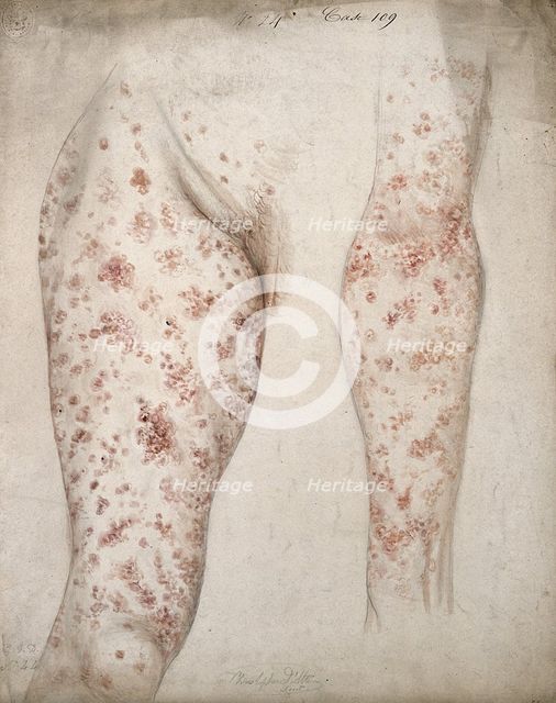 Sores and diseased skin on the leg and arm of a woman, 1856. Creator: Christopher D'Alton.
