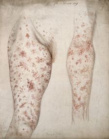 Sores and diseased skin on the leg and arm of a woman, 1856. Creator: Christopher D'Alton