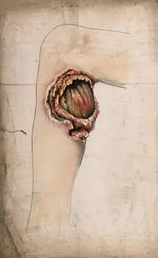 Severely diseased area of tissue on the calf of a woman's leg, (18)58. Creator: Christopher D'Alton