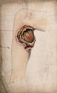 Severely diseased area of tissue on the calf of a woman's leg, (18)58. Creator: Christopher D'Alton