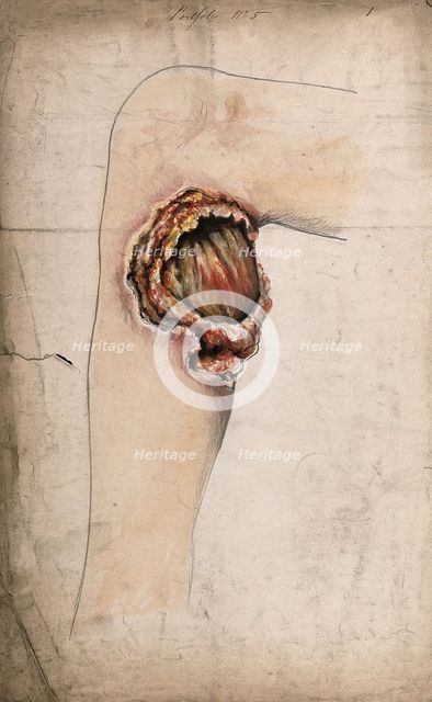 Severely diseased area of tissue on the calf of a woman's leg, (18)58. Creator: Christopher D'Alton.