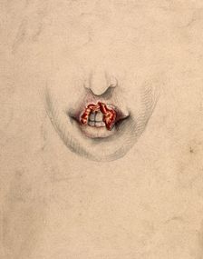 Severely diseased tissue on the upper lip of a woman suffering from tertiary syphilis, 1869. Creator: Christopher D'Alton
