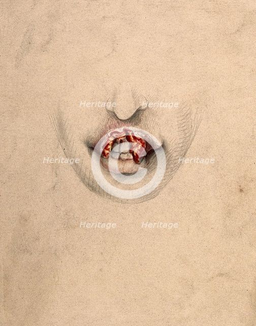 Severely diseased tissue on the upper lip of a woman suffering from tertiary syphilis, 1869. Creator: Christopher D'Alton.