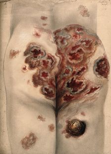Severely diseased tissue on the buttocks and thighs of a man, 1867. Creator: Christopher D'Alton
