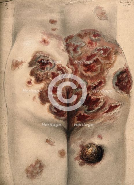 Severely diseased tissue on the buttocks and thighs of a man, 1867. Creator: Christopher D'Alton.