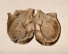 Section through polypus uteri, 1831. Creator: Unknown