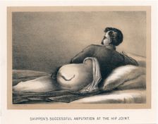 Shippen's Successful Amputation at the Hip Joint American Civil War, 1865