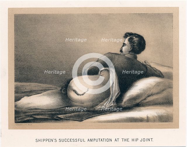'Shippen's Successful Amputation at the Hip Joint', American Civil War, 1865. Artist: Unknown