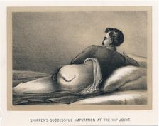 Shippen's Successful Amputation at the Hip Joint American Civil War, 1865