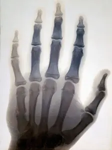 Sir Gervas Powell Glyn, 6th Bart: radiograph of his hand, 1896. Creator: Sir GP Glyn