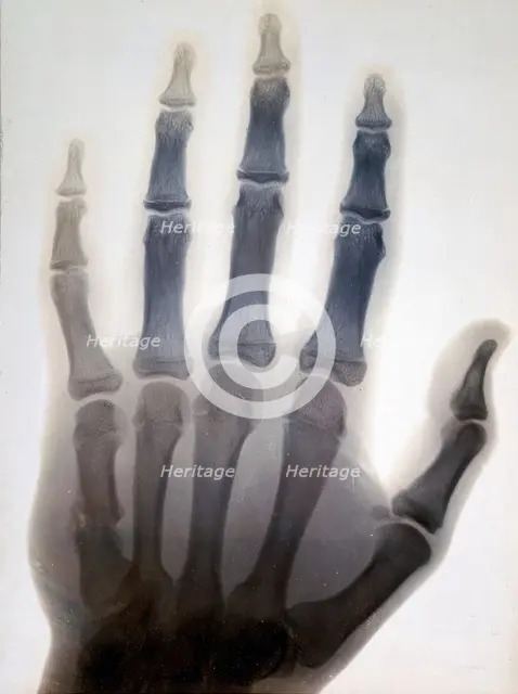 Sir Gervas Powell Glyn, 6th Bart: radiograph of his hand, 1896. Creator: Sir GP Glyn.