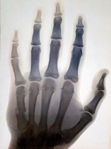 Sir Gervas Powell Glyn, 6th Bart: radiograph of his hand, 1896. Creator: Sir GP Glyn