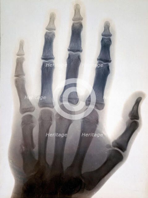 Sir Gervas Powell Glyn, 6th Bart: radiograph of his hand, 1896. Creator: Sir GP Glyn.