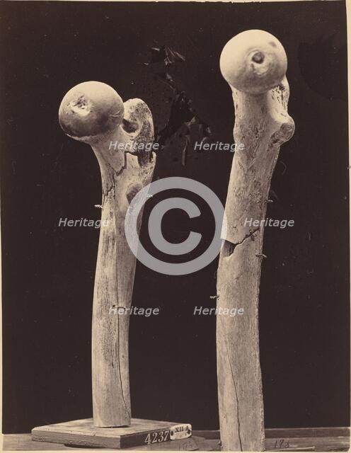 Specimens of Gunshot Fractures of the Femur, c. 1867. Creator: Unknown.