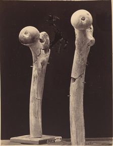 Specimens of Gunshot Fractures of the Femur, c. 1867. Creator: Unknown