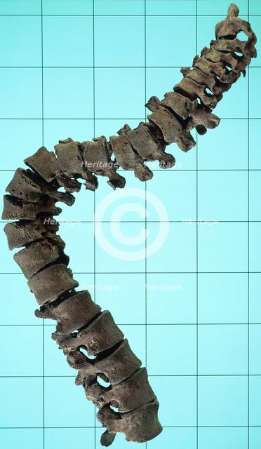 Spinal column showing the curvature of the spine. Creator: Unknown.