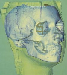 Stages in facial reconstruction of the bathrocranic skull. Creator: Unknown