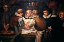 Surgeons performing an operation on a woman's breast in the seventeenth century. Creator: Unknown