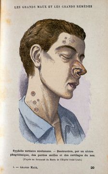 Symptoms of the tertiary phase of syphilis, c19th century. Creator: Unknown