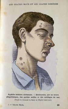 Symptoms of the tertiary phase of syphilis, c19th century