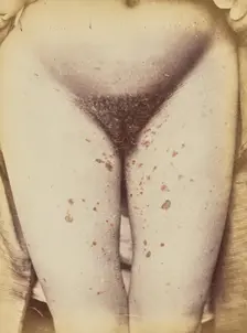 Syphilide, 1871. Creator: Arthur de Montmeja