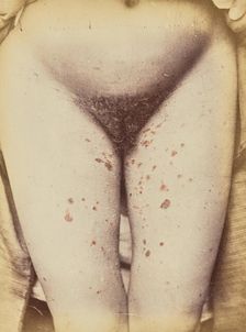 Syphilide, 1871. Creator: Arthur de Montmeja