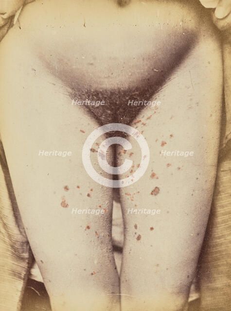 Syphilide, 1871. Creator: Arthur de Montmeja.