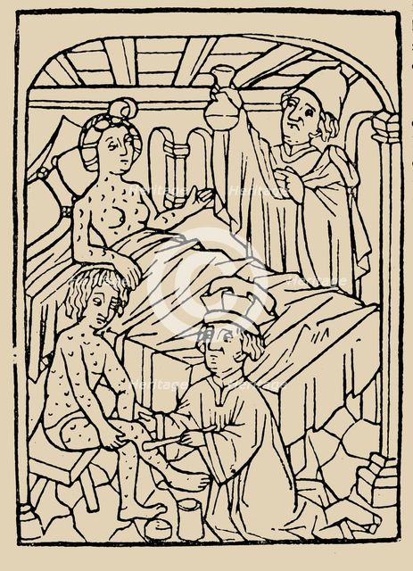 Syphilis treatment: Treatment with ointments (mercury). From: A Malafranczos morbo gallorum preserv