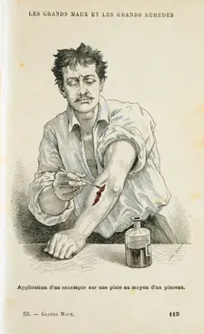 Painting a wound with an antiseptic solution, c1890. Creator: Unknown