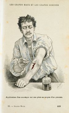 Painting a wound with an antiseptic solution, c1890. Creator: Unknown