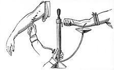 Person-to person blood transfusion, 1833. Creator: Unknown