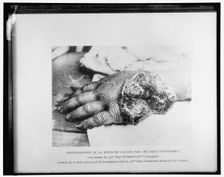 Photographie de la blessure causée par une balle explosible..., 1914. Creator: Harris & Ewing