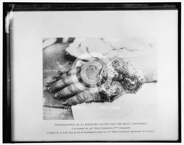 Photographie de la blessure causée par une balle explosible..., 1914. Creator: Harris & Ewing.