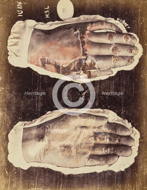 Psoriasis scarlatiniforme, 1871. Creator: Arthur de Montmeja.