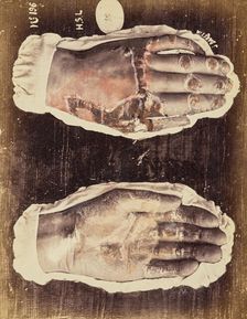 Psoriasis scarlatiniforme, 1871. Creator: Arthur de Montmeja