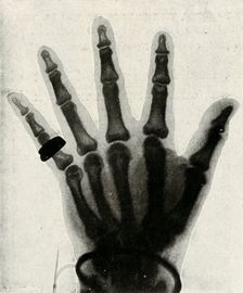 Radiograph of the Hand of H.R.H. The Prince of Wales (c1897)