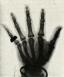 Radiograph of the Hand of H.R.H. The Prince of Wales (c1897)