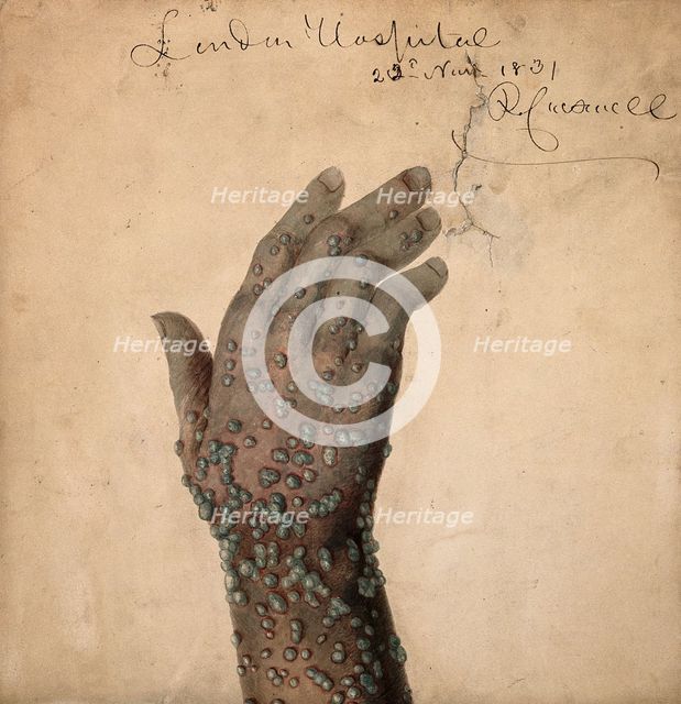 Rash of pustules on the hand of a patient, probably suffering from smallpox, 1831. Creator: Robert Carswell.