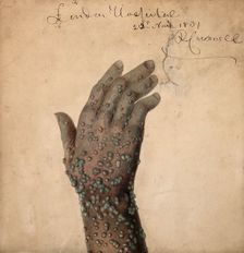 Rash of pustules on the hand of a patient, probably suffering from smallpox, 1831. Creator: Robert Carswell