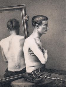 Recovering casualty of a bullet wound to the abdomen, American Civil War, 1865