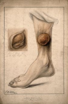 Tertiary tubercular elephantiasis on the thigh and calf of a woman, 1874. Creator: Christopher D'Alton