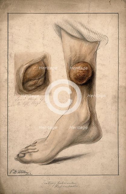 Tertiary tubercular elephantiasis on the thigh and calf of a woman, 1874. Creator: Christopher D'Alton.