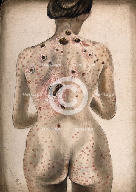 The back, buttocks and arms of a woman, displaying areas of diseased tissue..., (1840/1870?). Creator: Christopher D'Alton.