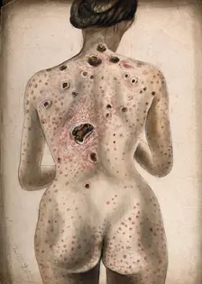 The back, buttocks and arms of a woman, displaying areas of diseased tissue..., (1840/1870?). Creator: Christopher D'Alton