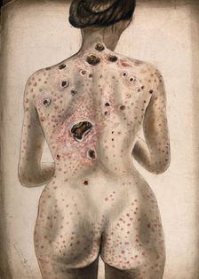 The back, buttocks and arms of a woman, displaying areas of diseased tissue..., (1840/1870?). Creator: Christopher D'Alton