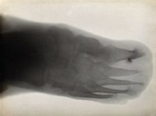 The bones of a foot, possibly with leprosy, viewed through x-ray, 1896