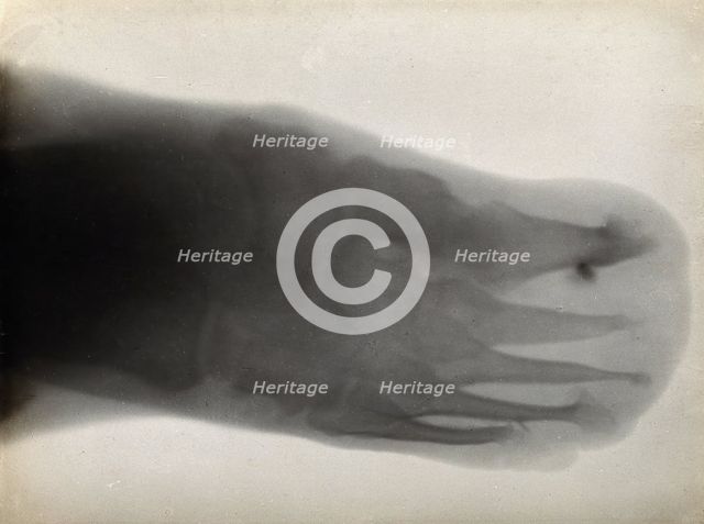The bones of a foot, possibly with leprosy, viewed through x-ray, 1896.